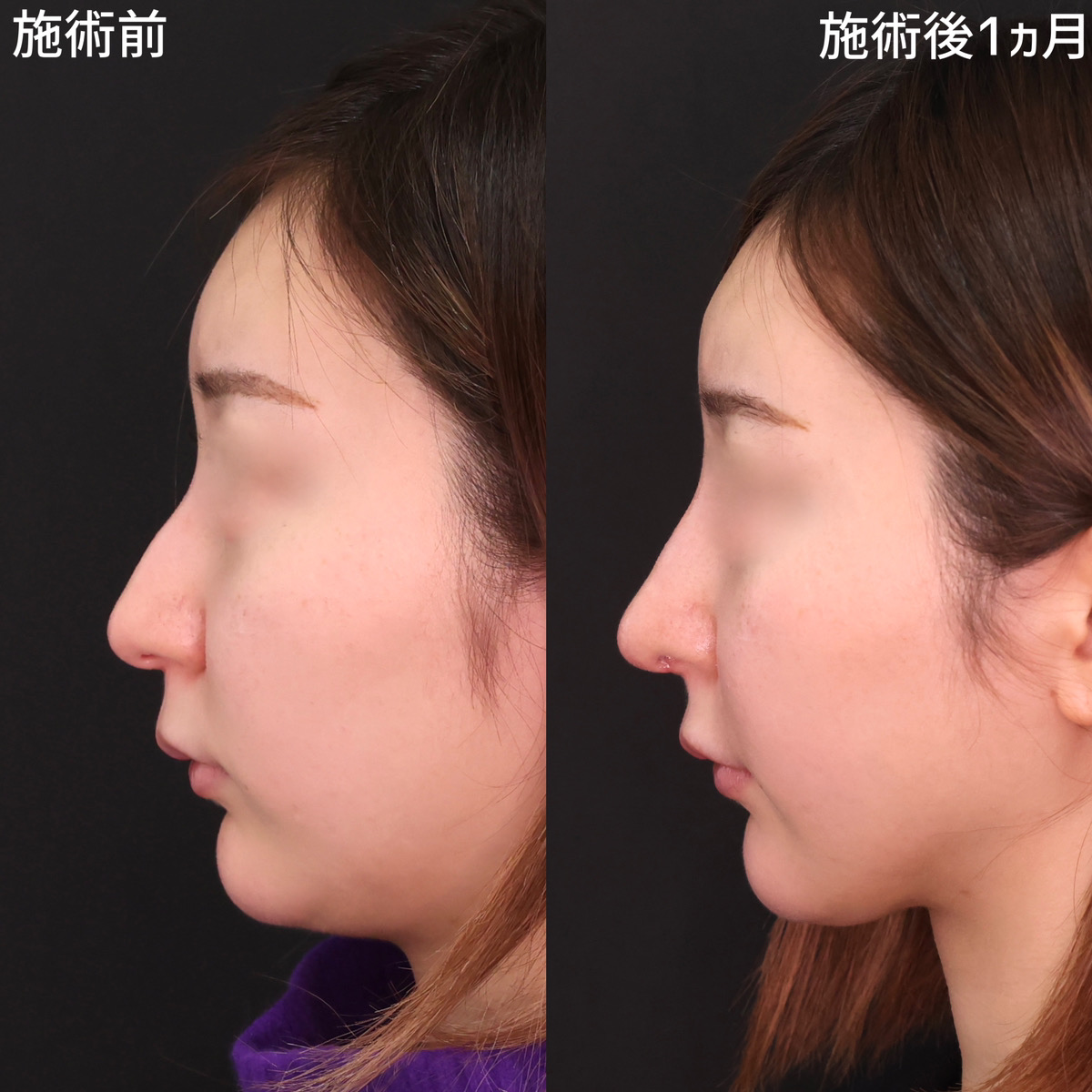 鼻尖形成・鼻尖縮小/鼻中隔延長術/隆鼻術（プロテーゼ・自家組織）の症例写真 施術前後 