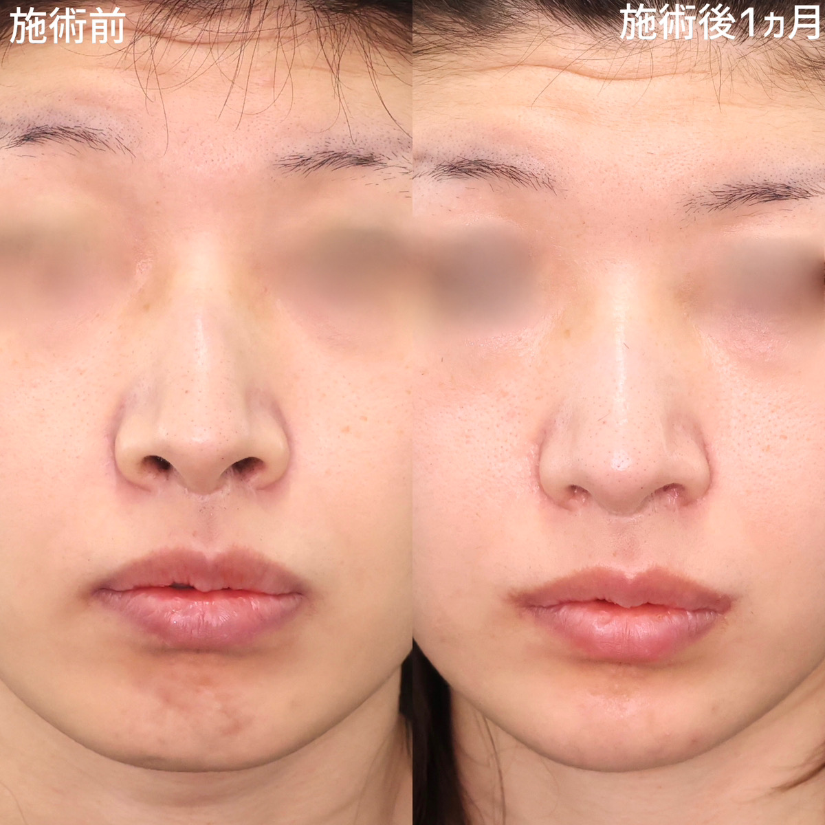 自然に上がった口角と鼻穴の見える面積が小さくなり、上品な印象に。