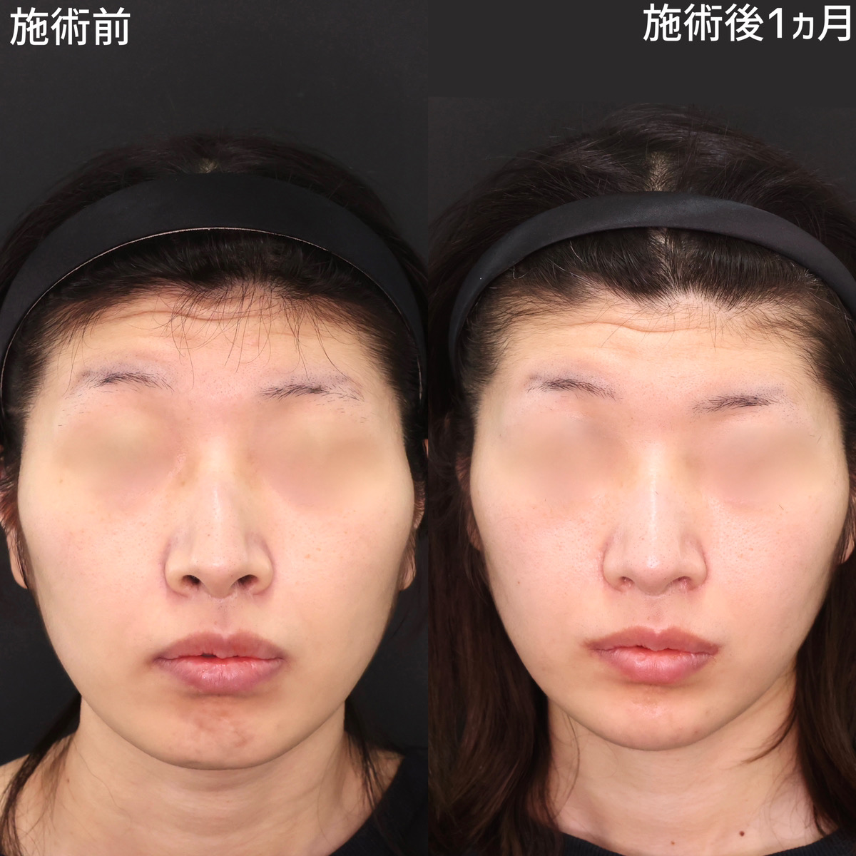 TAC式 鼻翼縮小術（小鼻縮小）/口角挙上・リフト（マイクロ切開法・内側法/口内法）/顎のヒアルロン酸注射の症例写真 施術前後 