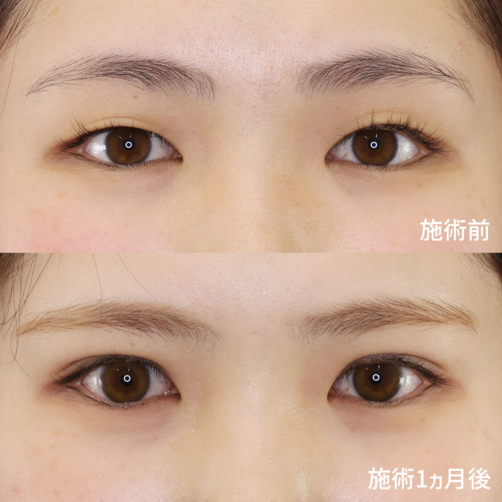 一重とさようなら。二重で新しい私が始まる【二重整形】