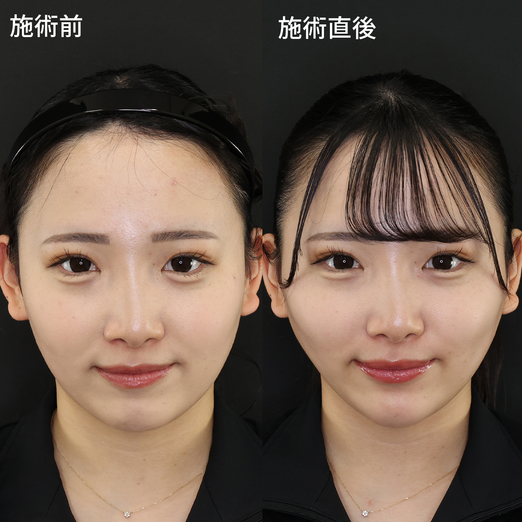 脂肪吸引せずに直後からこの変化！究極の糸リフト効果で即日顔痩せ！