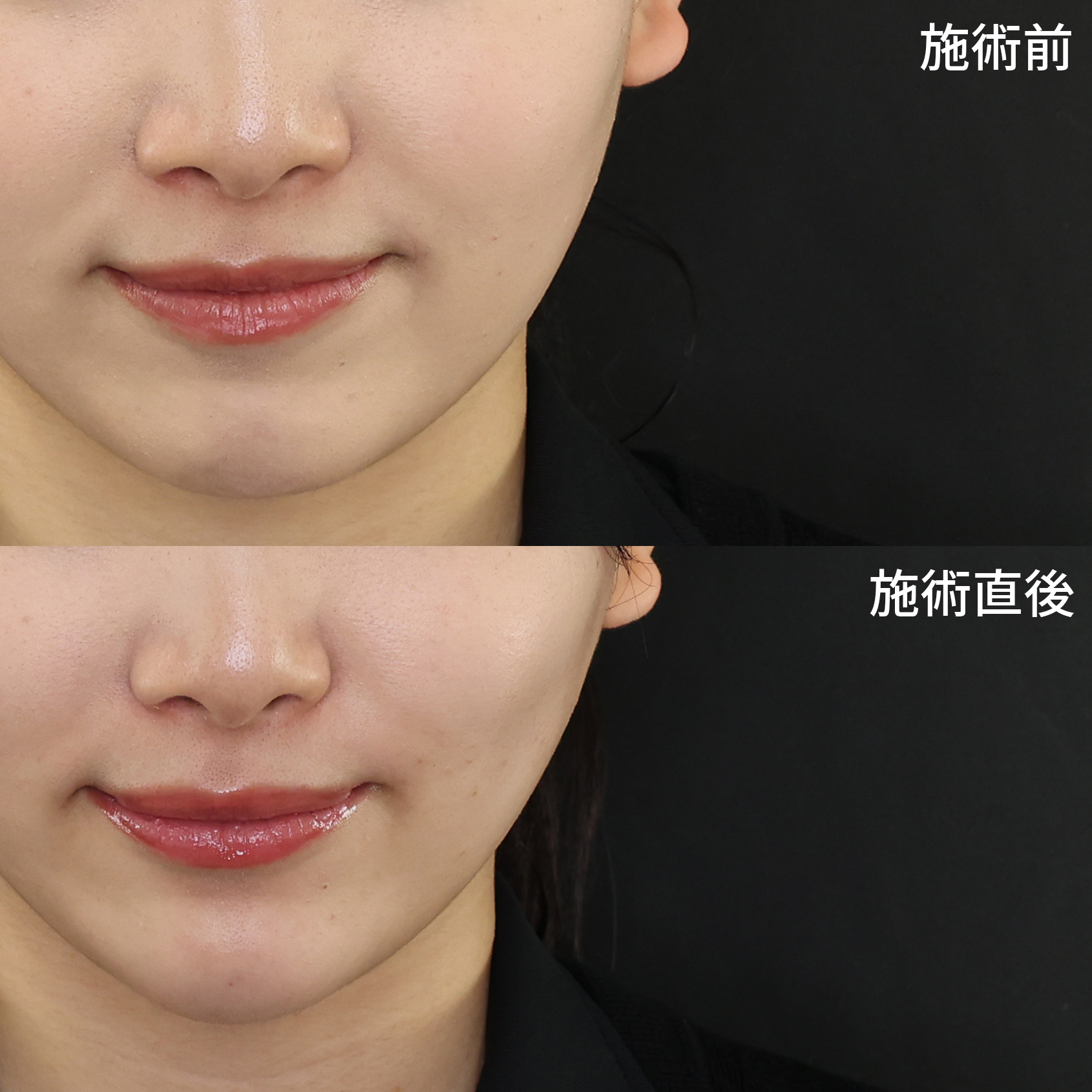 TAC式 ツヤ肌コラーゲンリフト®/顎のヒアルロン酸注射の症例写真 施術前後 