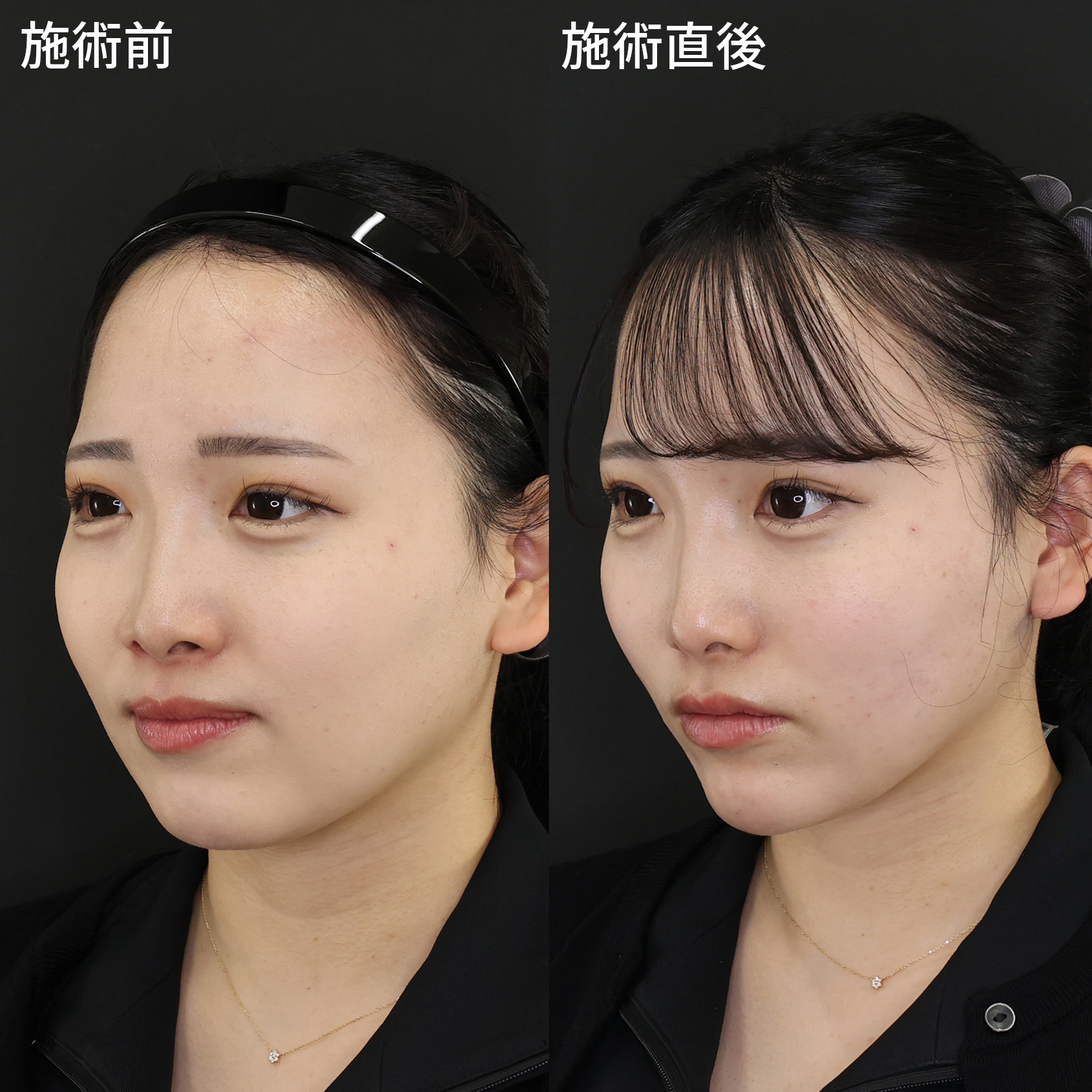 TAC式 ツヤ肌コラーゲンリフト®/顎のヒアルロン酸注射の症例写真 施術前後 