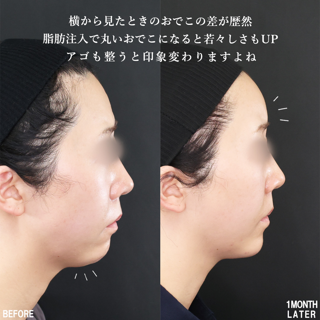 TAC式 ツヤ肌コラーゲンリフト®/顔の脂肪注入(コンデンスリッチフェイス)/おでこの脂肪注入(オルチャンデコ形成)の症例写真 施術前後