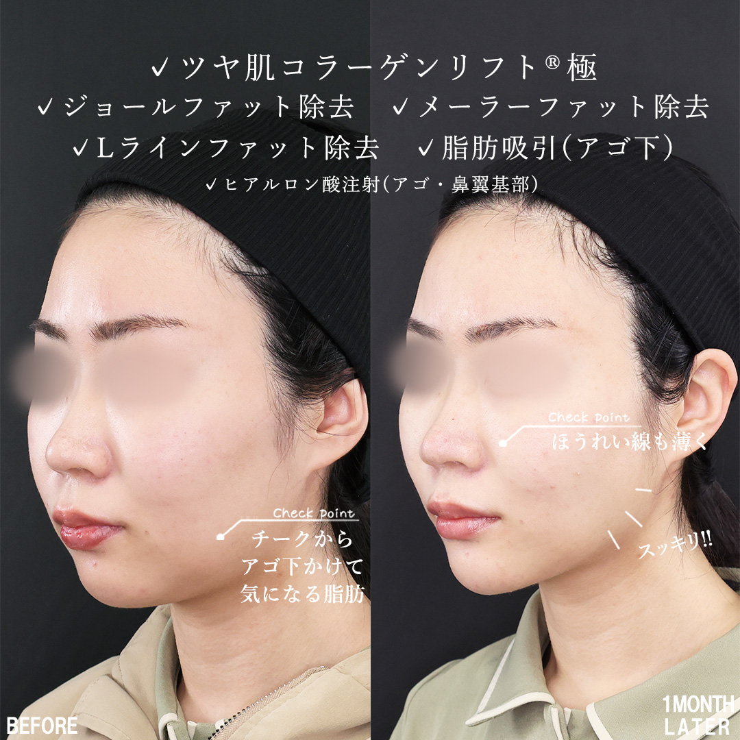 TAC式 ツヤ肌コラーゲンリフト®/ジョールファット除去/メーラーファット除去の症例写真 施術前後 