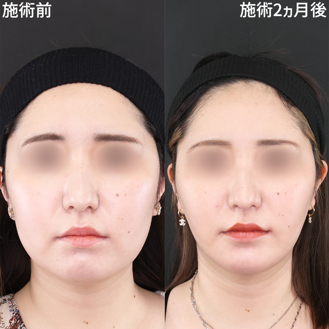 ひとまわり小顔に【脂肪除去×糸リフト】