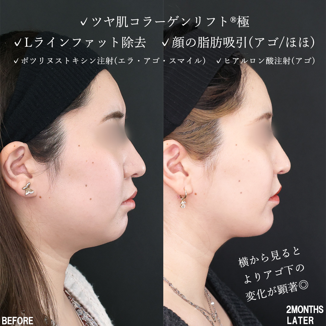TAC式 ツヤ肌コラーゲンリフト®/Lラインファット除去（エラ下脂肪除去）/顔の脂肪吸引の症例写真 施術前後 