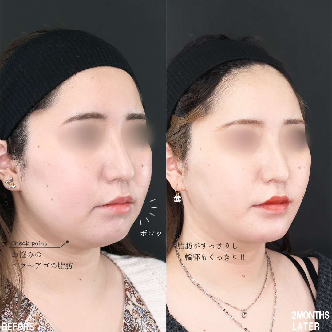 TAC式 ツヤ肌コラーゲンリフト®/Lラインファット除去（エラ下脂肪除去）/顔の脂肪吸引の症例写真 施術前後 