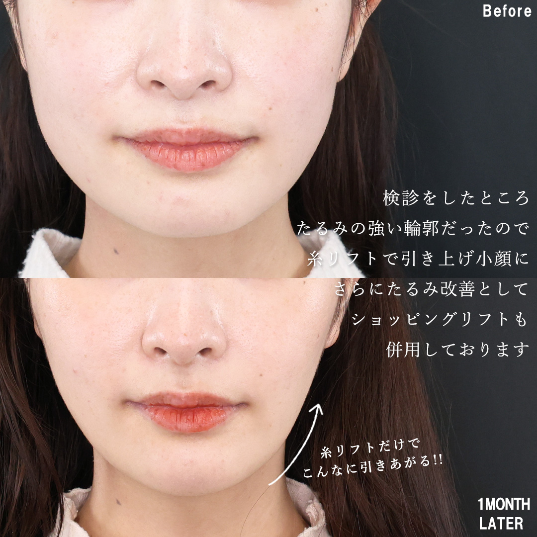 TAC式 ツヤ肌コラーゲンリフト®/TAC式 ショッピングリフト/エラボトックス注射の症例写真 施術前後 