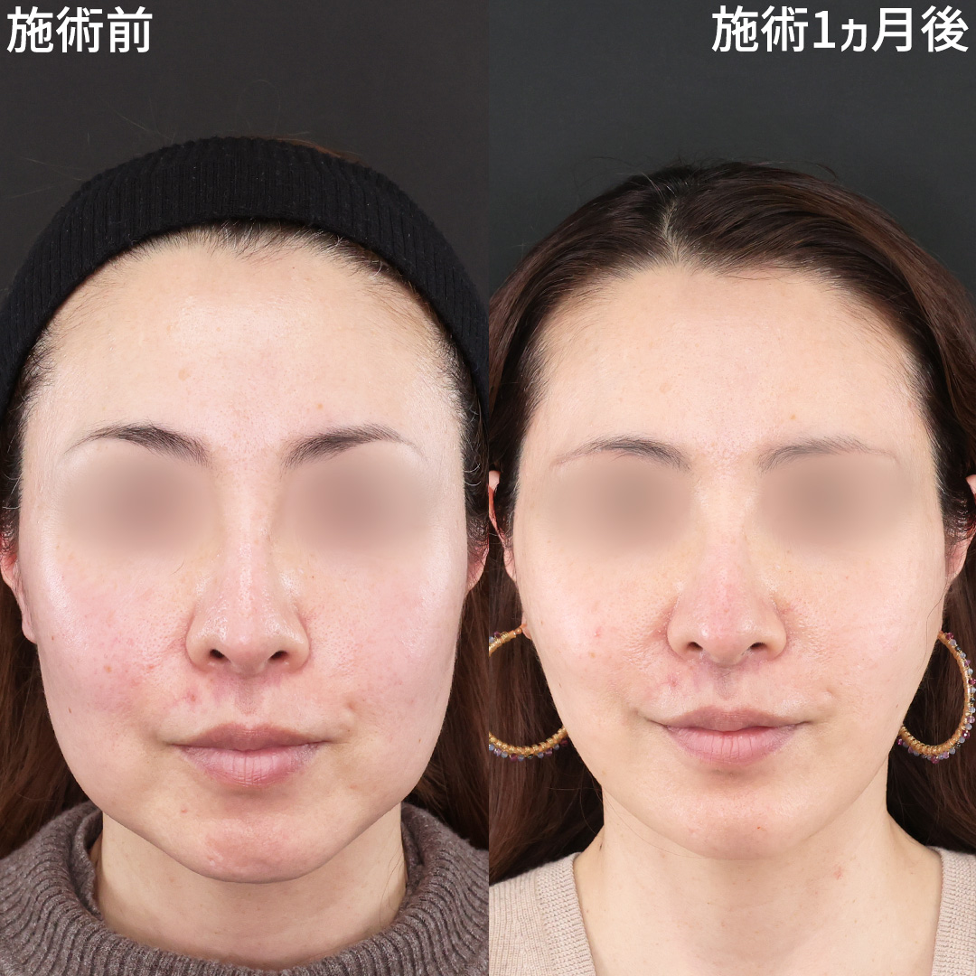 【50代】輪郭のもたつき・たるみを解消【糸リフト×脂肪除去】