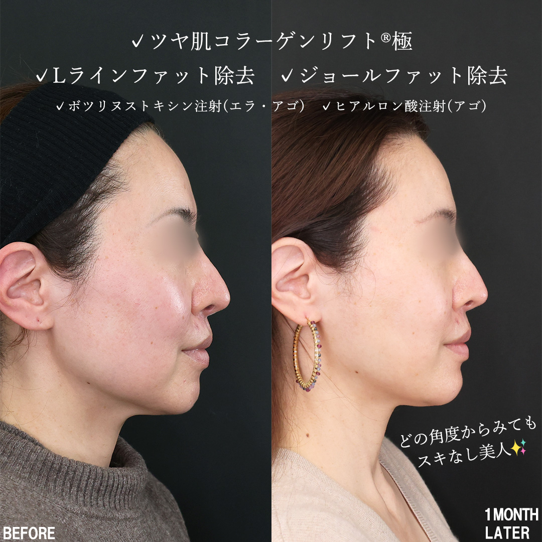 小顔整形｜パーフェクトフェイスライン/TAC式 ツヤ肌コラーゲンリフト®/ジョールファット除去の症例写真 施術前後 
