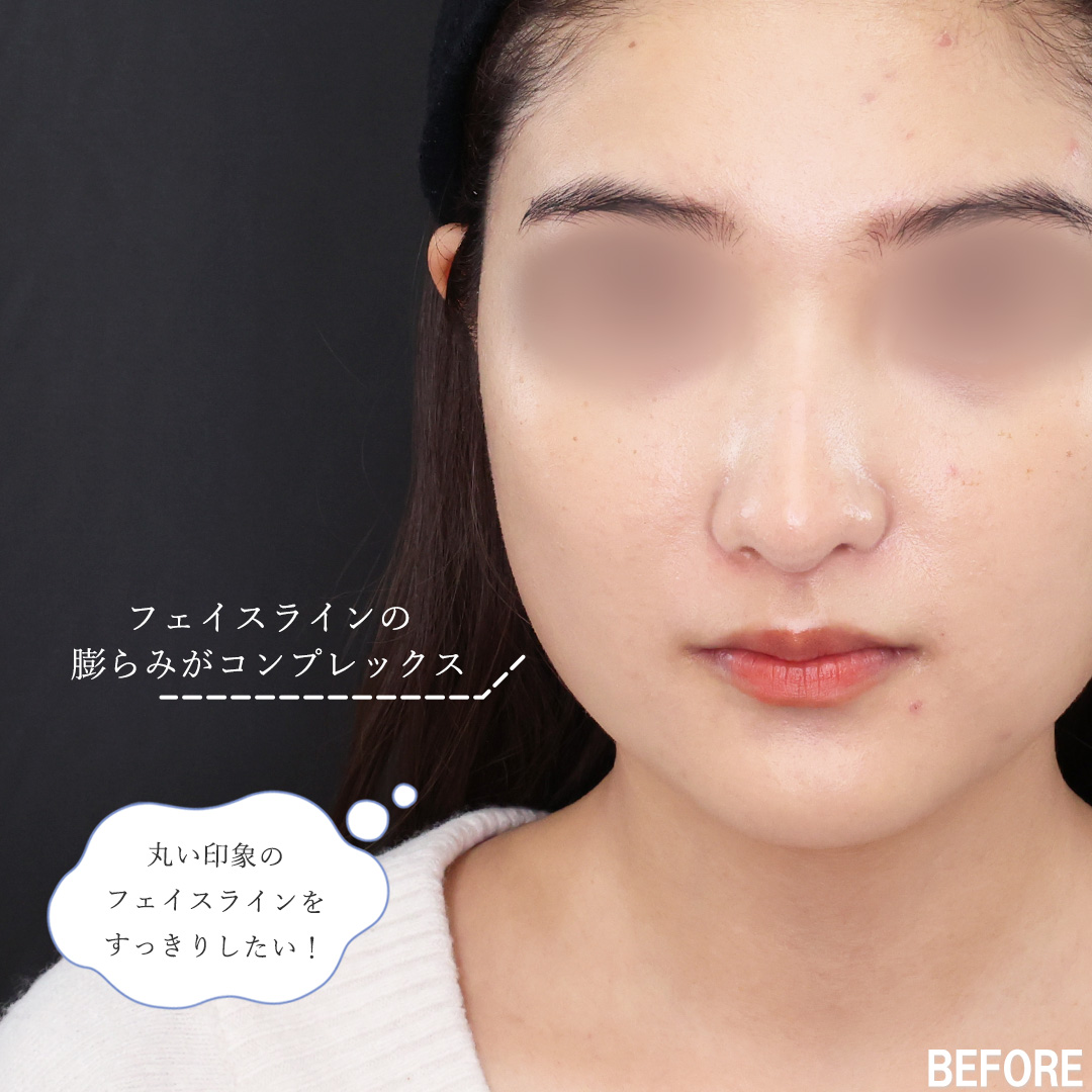 TAC式 ツヤ肌コラーゲンリフト®/バッカルファット除去/Lラインファット除去（エラ下脂肪除去）の症例写真 施術前後 