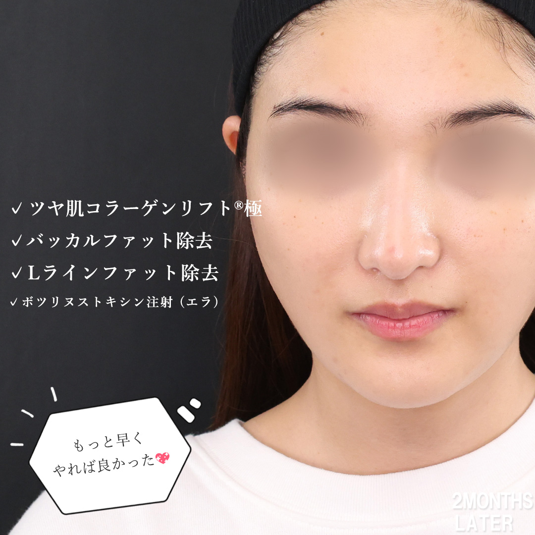 TAC式 ツヤ肌コラーゲンリフト®/バッカルファット除去/Lラインファット除去（エラ下脂肪除去）の症例写真 施術前後 