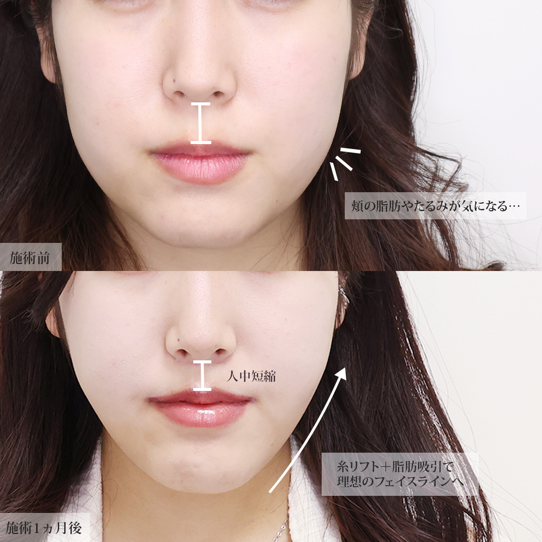 TAC式 ツヤ肌コラーゲンリフト®/顔の脂肪吸引/ジョールファット除去の症例写真 施術前後 