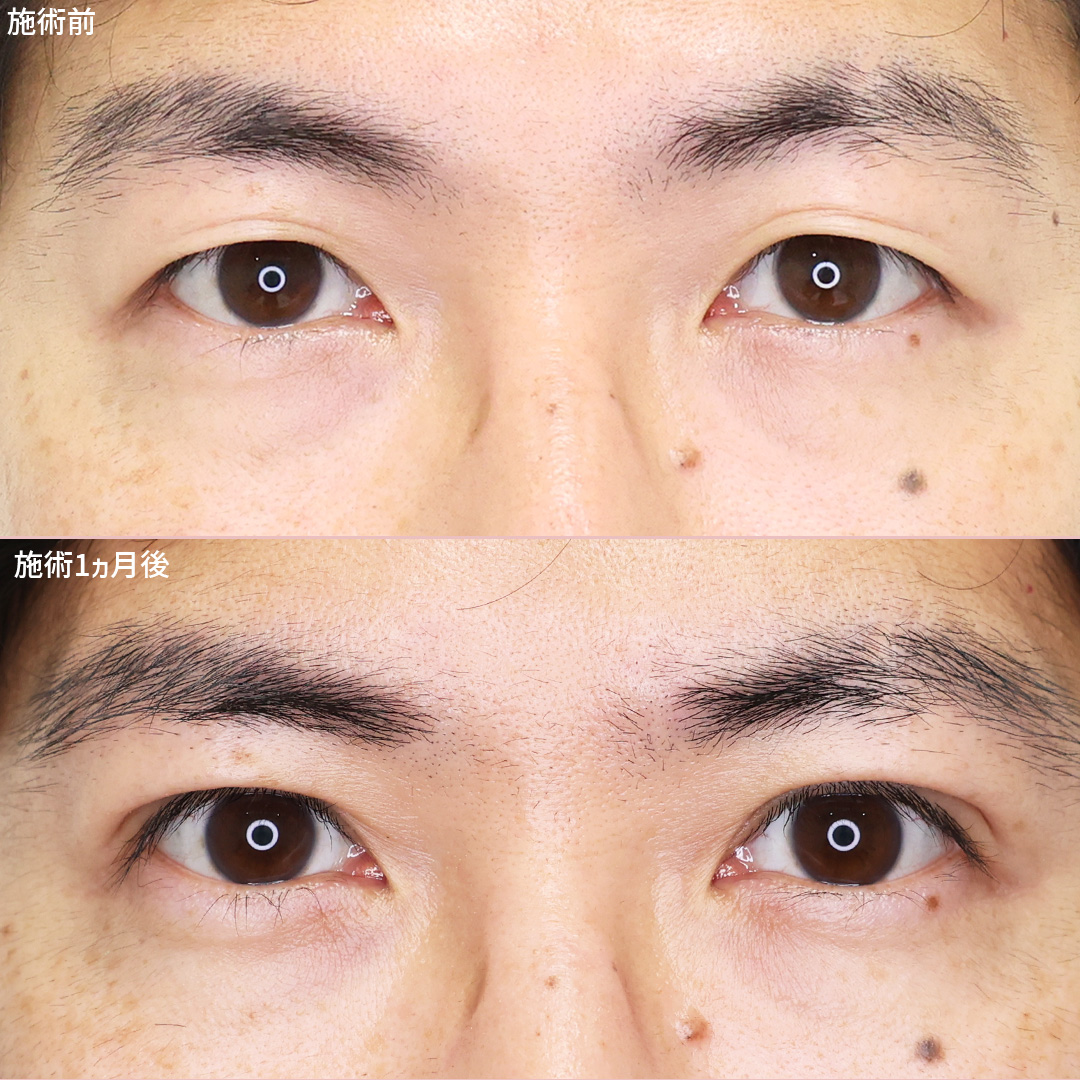 《男性の埋没法》年々気になる目元のお悩み