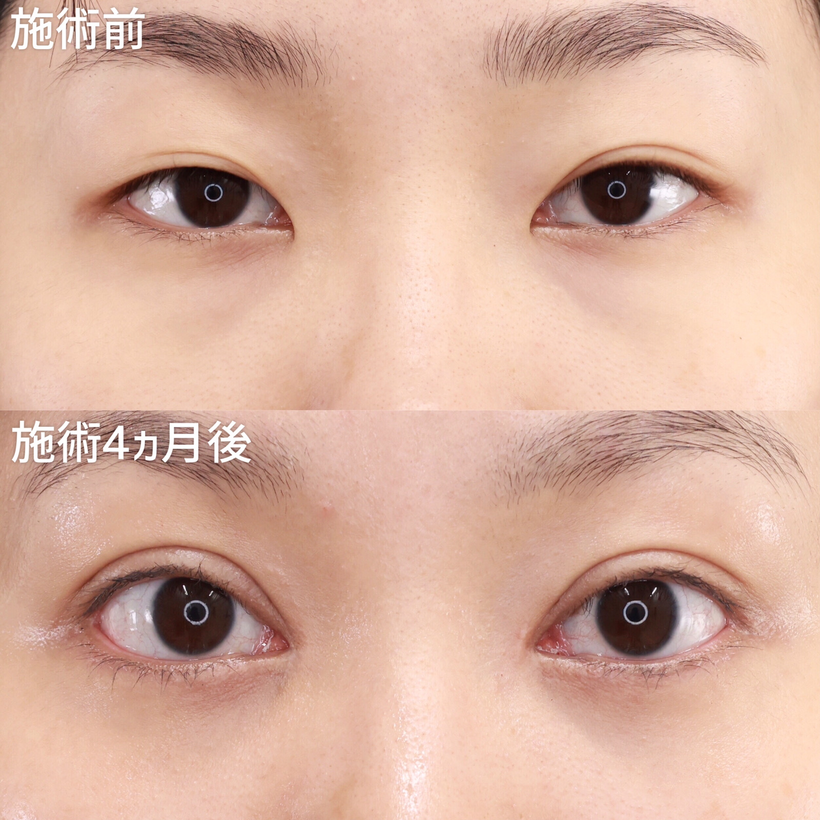 【目元フル】 二重全切開&目頭切開&グラマラスライン&目尻切開で目元を一回り大きく!