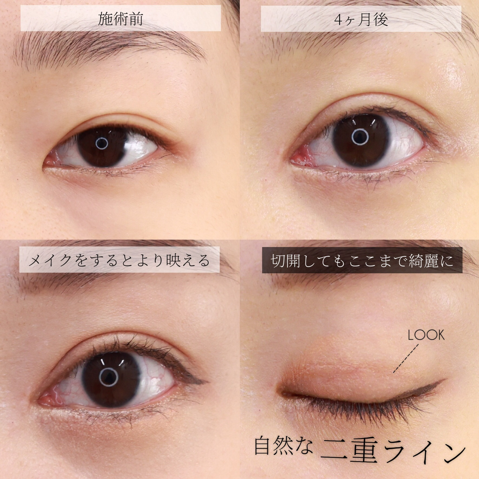 二重切開（全切開法）/目頭切開術/目尻切開術の症例写真 施術前後 