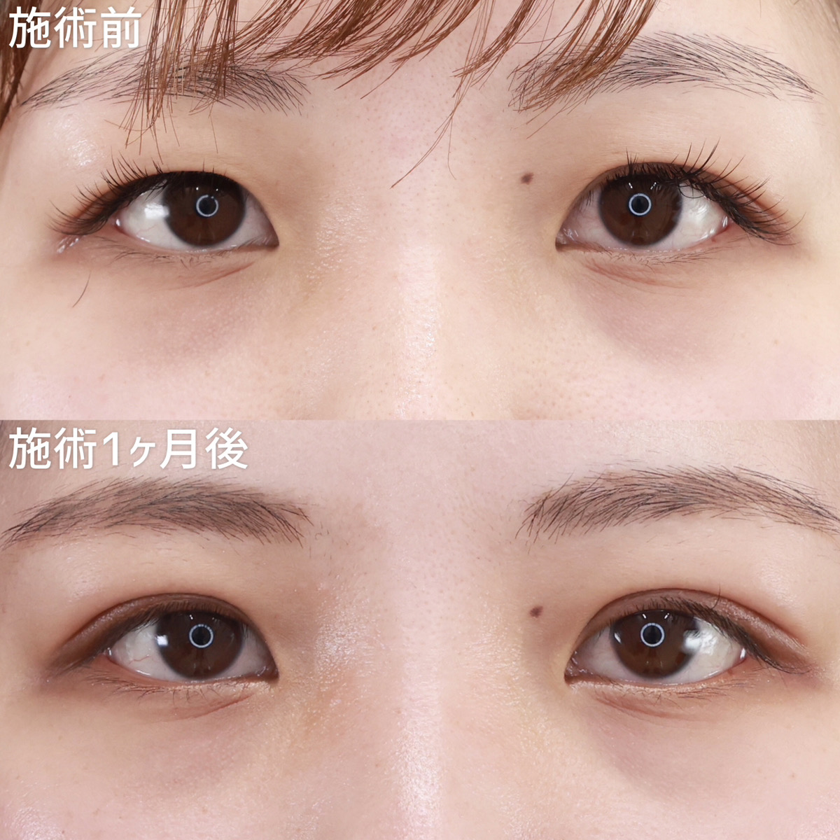 【二重埋没法】左右差を整えつつ二重線をハッキリとさせる。