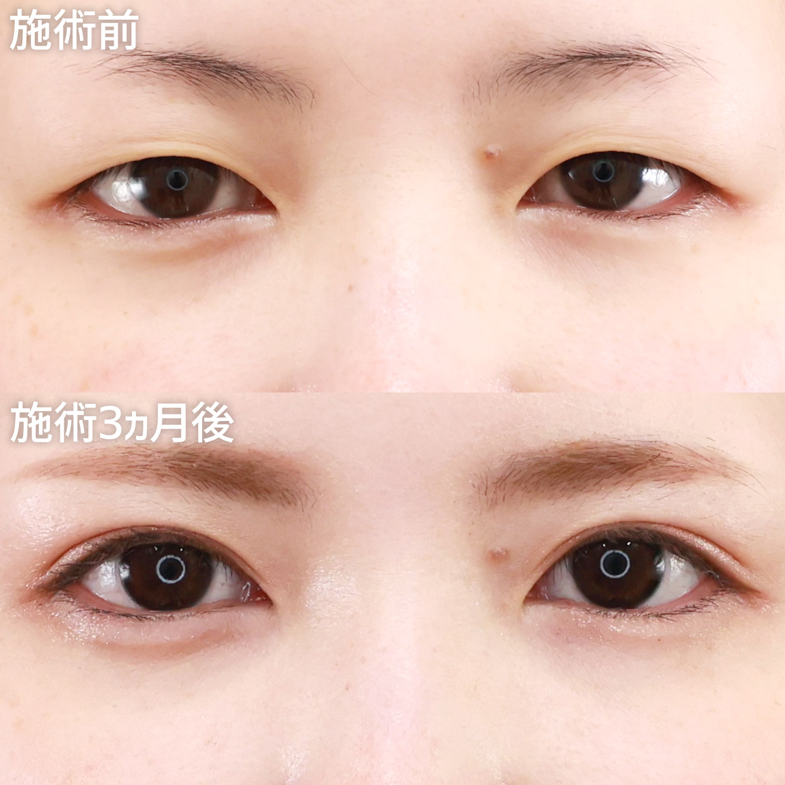 【二重全切開】整形感なし！控えめの二重幅でナチュラルな仕上がりのMIX二重に