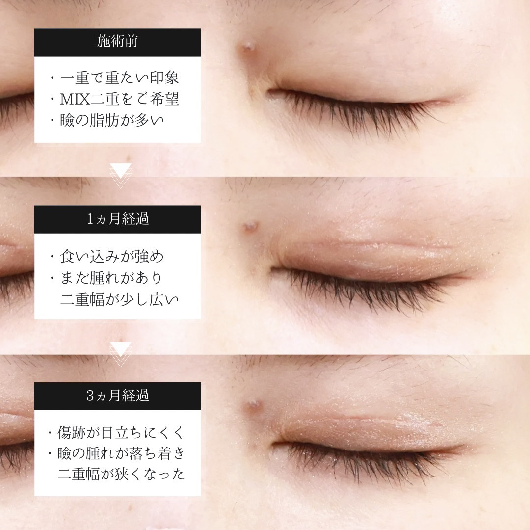 二重切開（全切開法）の症例写真 施術前後 