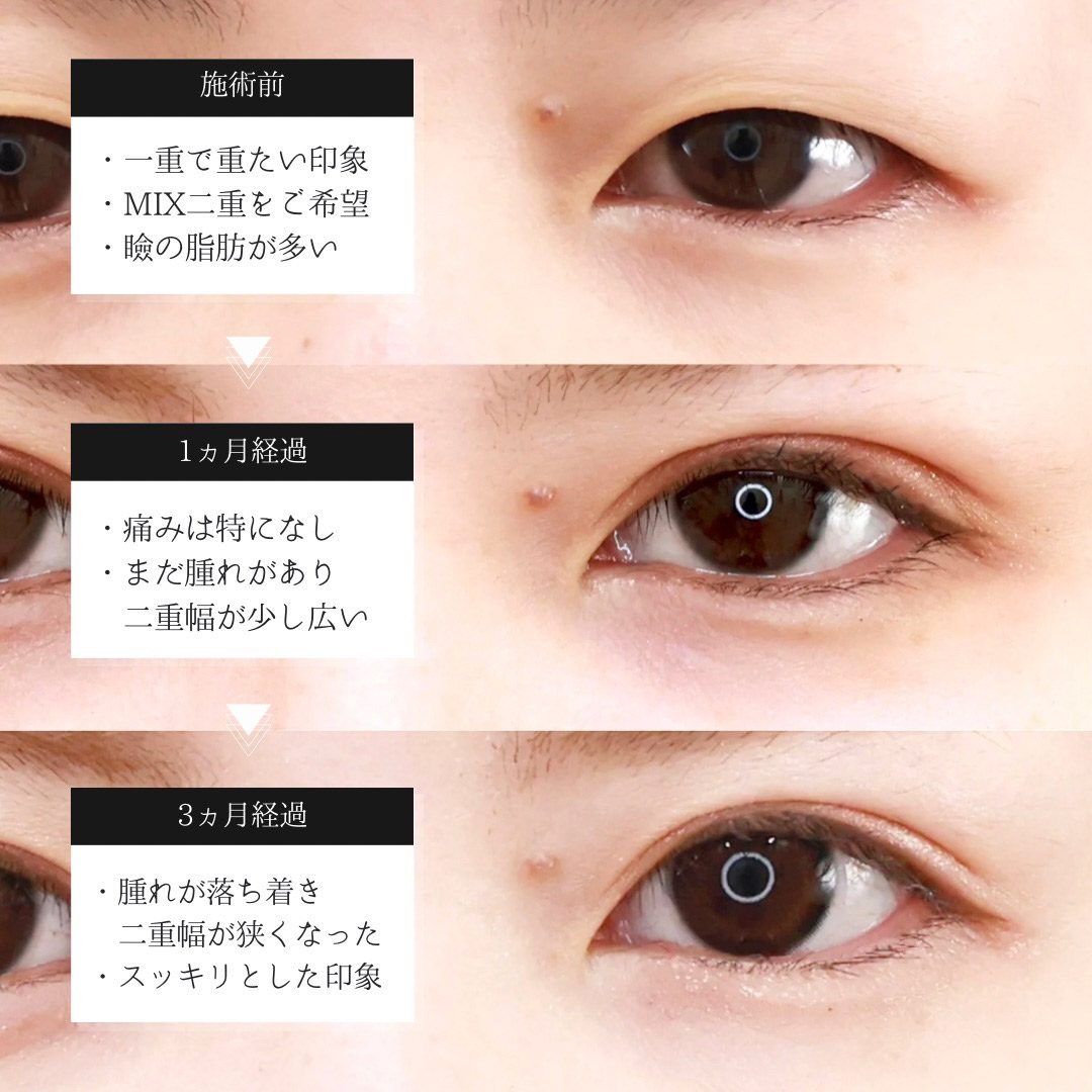 二重切開（全切開法）の症例写真 施術前後 