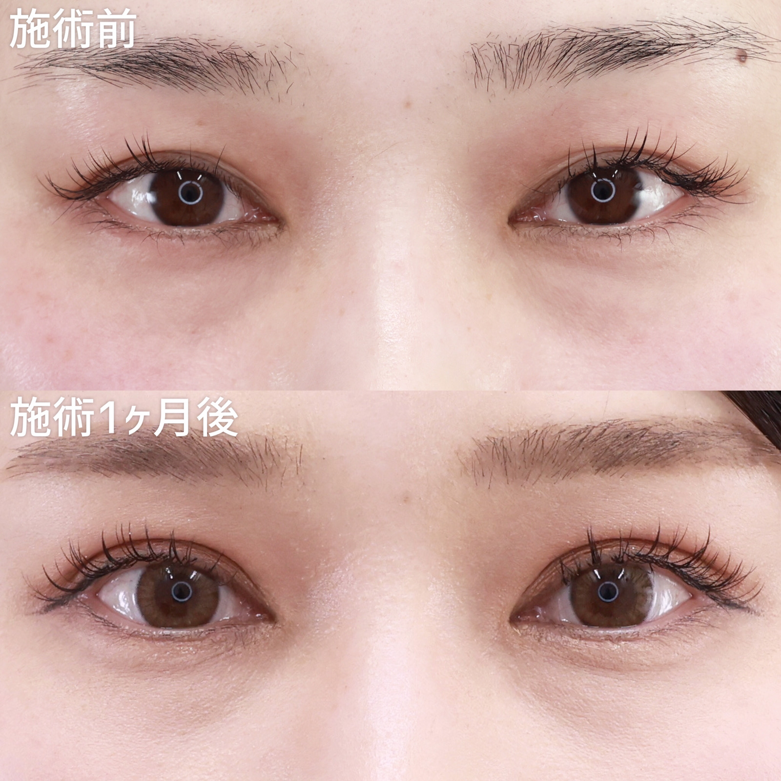 【二重埋没法】少しの二重幅の変化でも、ここまで変わる。