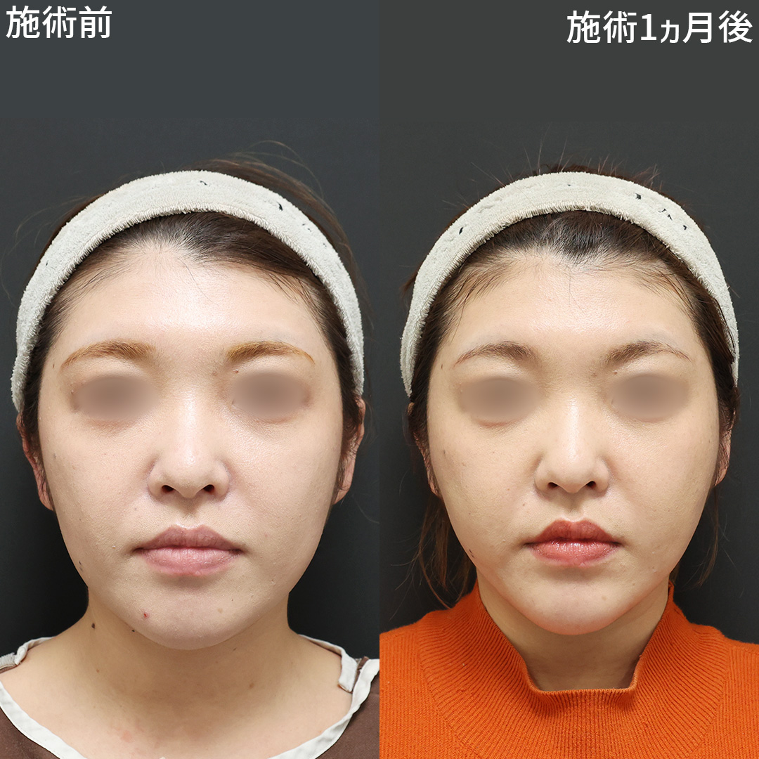 《小顔施術》で理想だったV字フェイスラインへ