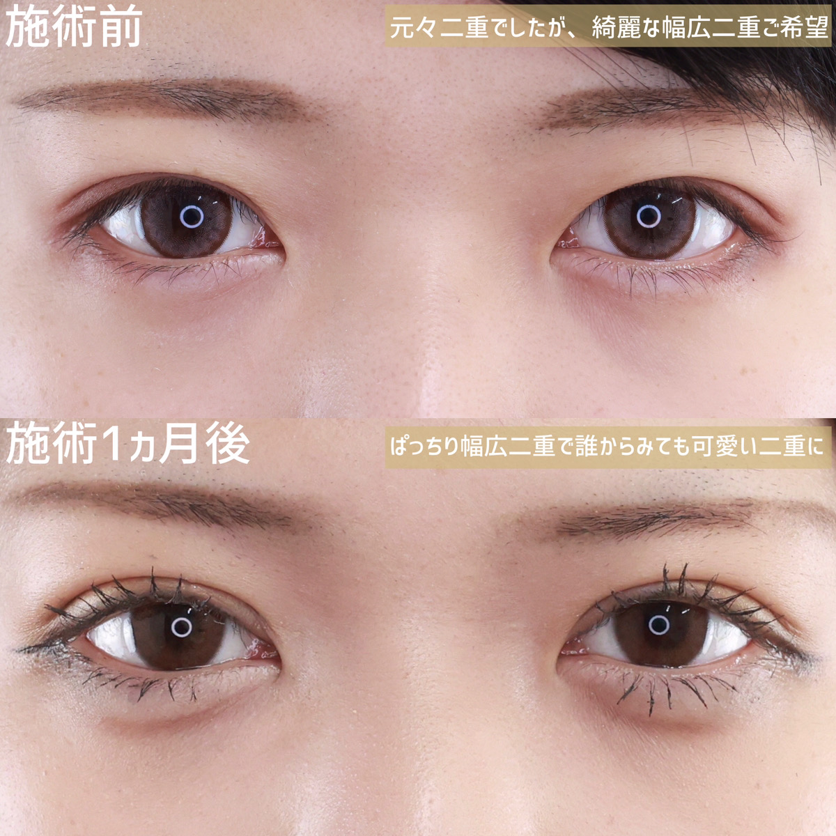 二重切開（全切開法）の症例写真 施術前後 