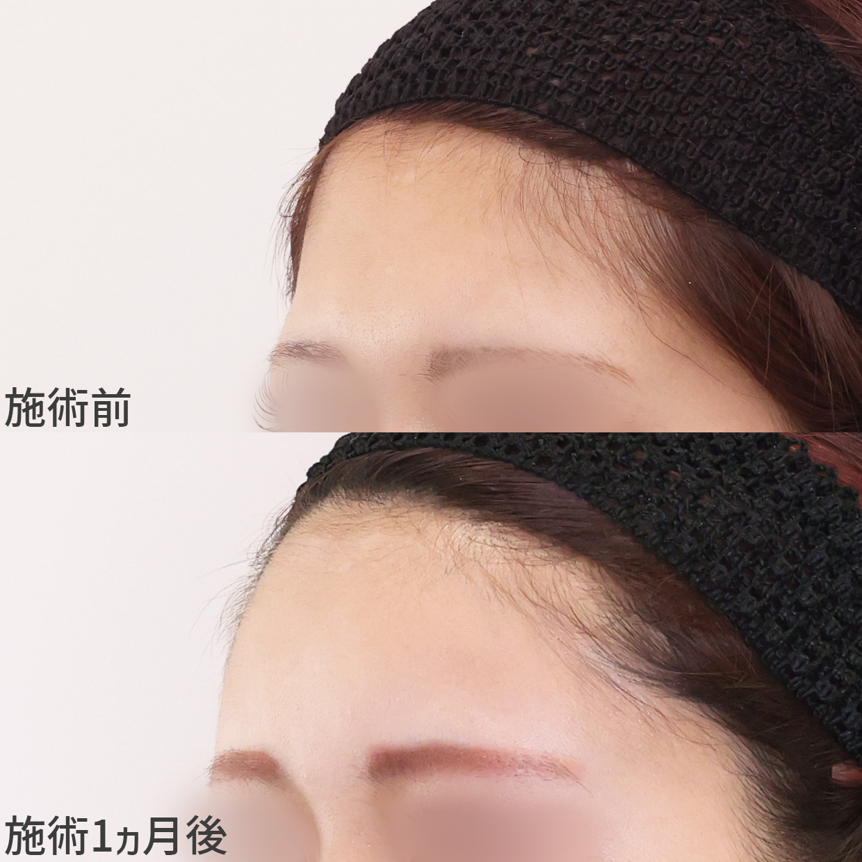 おでこが丸いと印象はどう変わる？脂肪注入でお顔の印象変化