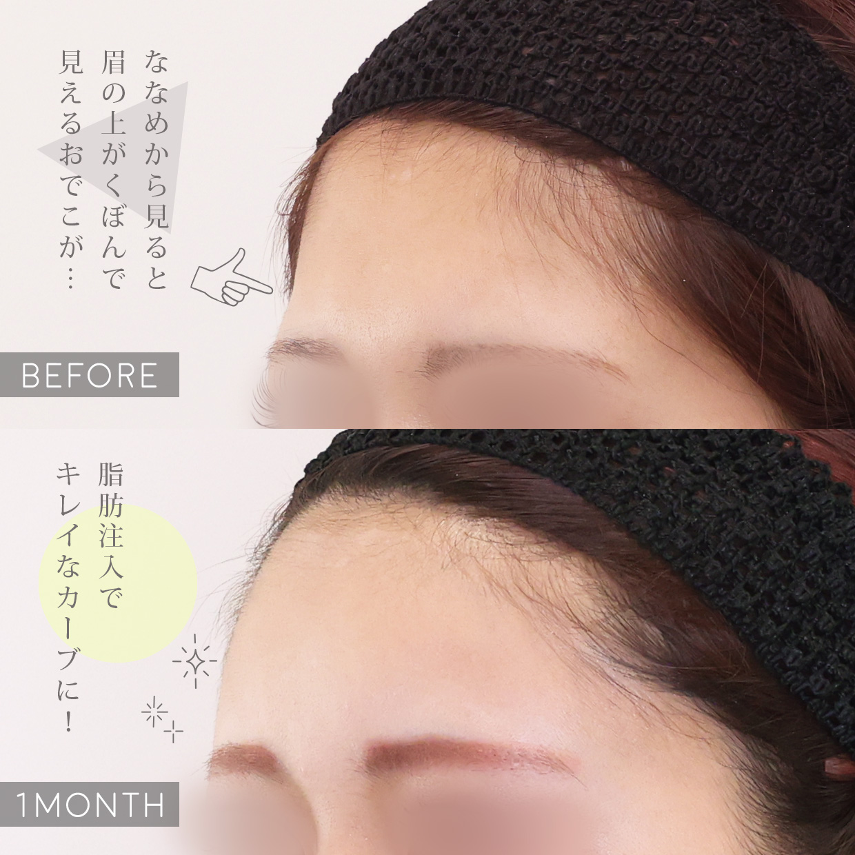 顔の脂肪注入(コンデンスリッチフェイス)の症例写真 施術前後