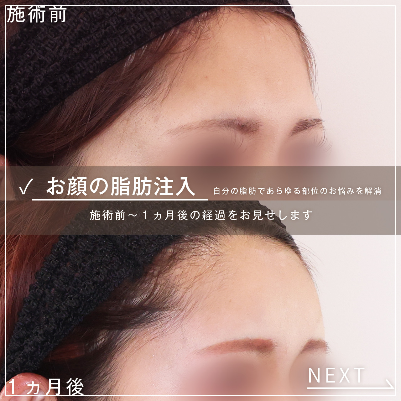 顔の脂肪注入(コンデンスリッチフェイス)の症例写真 施術前後