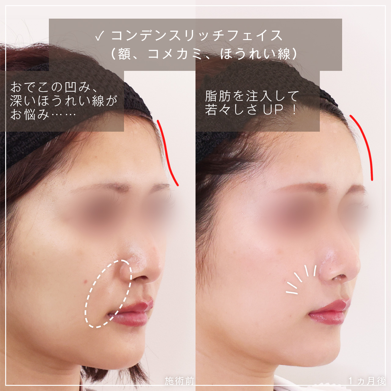 顔の脂肪注入(コンデンスリッチフェイス)の症例写真 施術前後