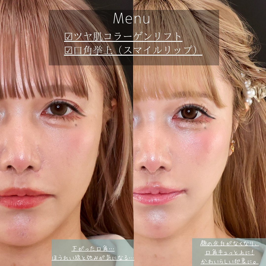 TAC式 ツヤ肌コラーゲンリフト®の症例写真 施術前後 