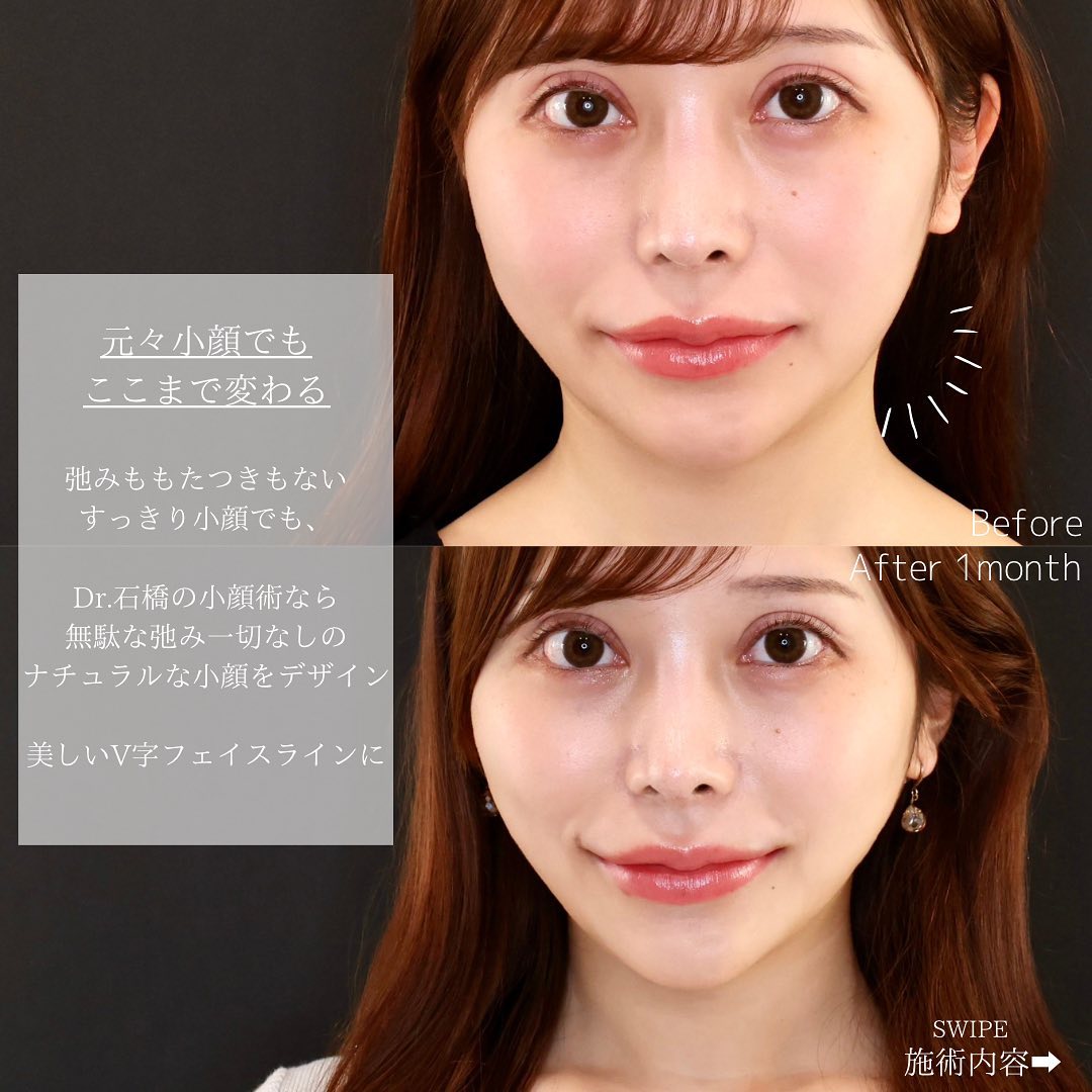 TAC式 ツヤ肌コラーゲンリフト®/エラボトックス注射の症例写真 施術前後 