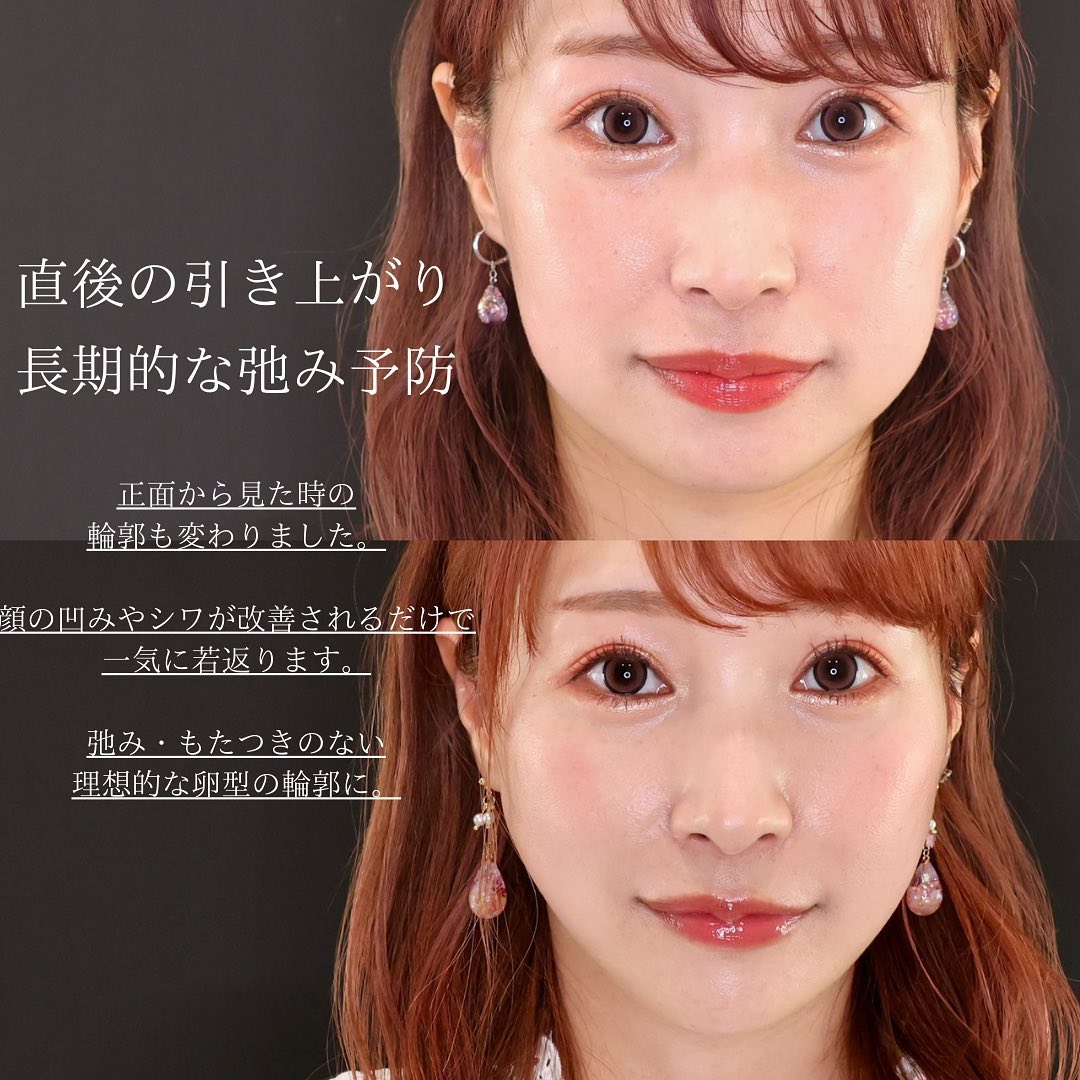 TAC式 ツヤ肌コラーゲンリフト®/ほうれい線のヒアルロン酸注射/顎のヒアルロン酸注射の症例写真 施術前後 