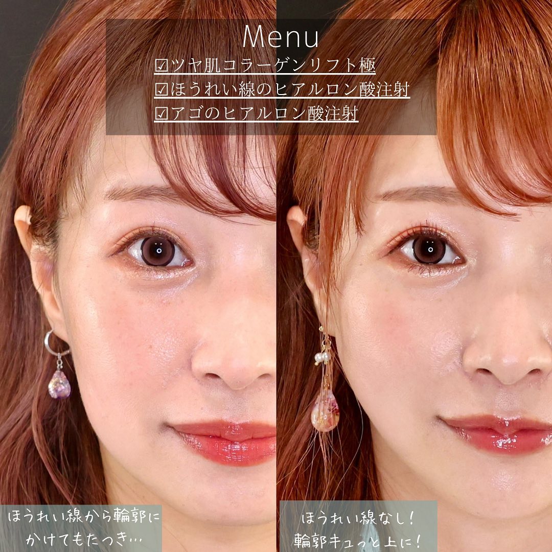 TAC式 ツヤ肌コラーゲンリフト®/ほうれい線のヒアルロン酸注射/顎のヒアルロン酸注射の症例写真 施術前後 