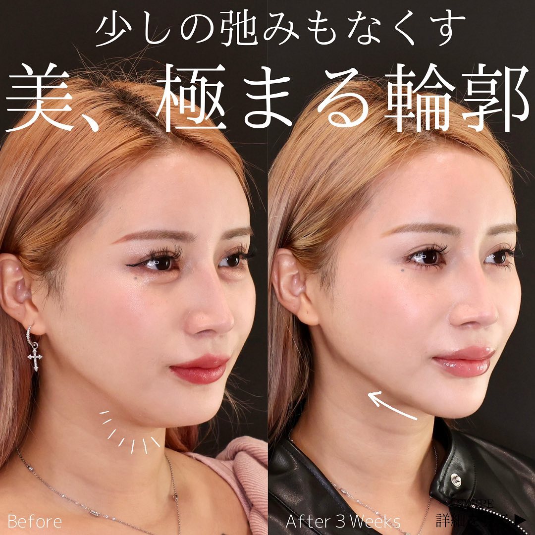 TAC式 ツヤ肌コラーゲンリフト®/エラボトックス注射/顎のヒアルロン酸注射の症例写真 施術前後 