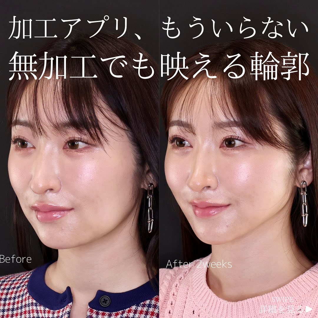 TAC式 ツヤ肌コラーゲンリフト®の症例写真 施術前後 