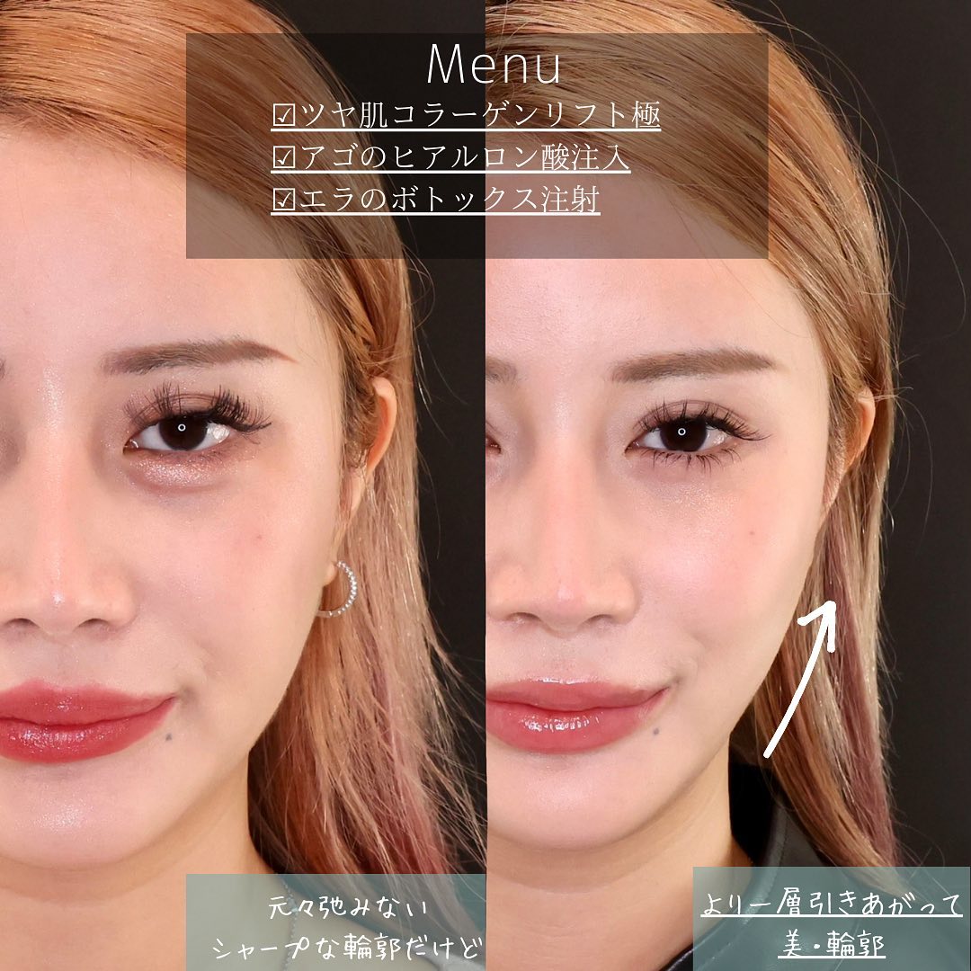 TAC式 ツヤ肌コラーゲンリフト®/エラボトックス注射/顎のヒアルロン酸注射の症例写真 施術前後 