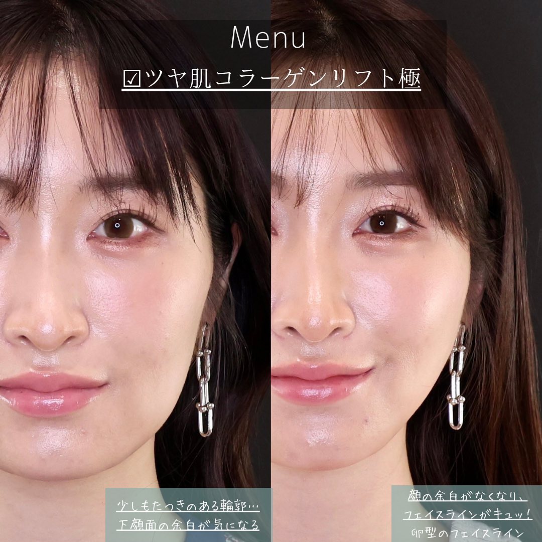 TAC式 ツヤ肌コラーゲンリフト®の症例写真 施術前後 