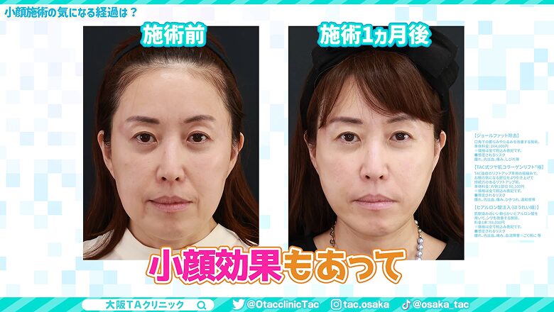施術前と1ヵ月後の正面からのビフォーアフター画像