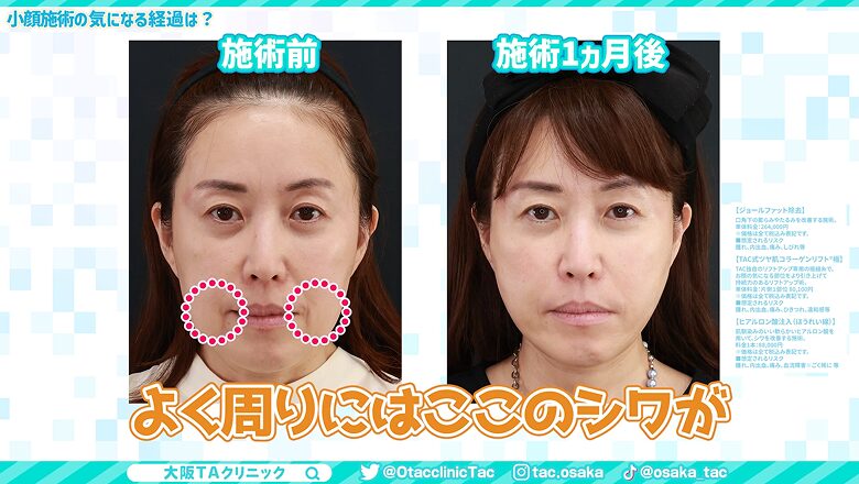 施術前と1ヵ月後の比較で口元のシワの改善を強調