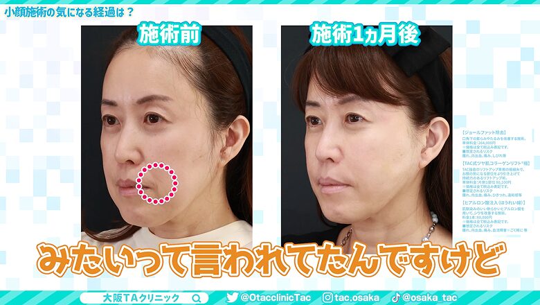 施術前と1ヵ月後の斜めからのビフォーアフター画像