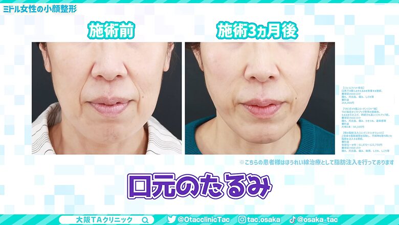 施術前と3ヵ月後のビフォーアフター画像
