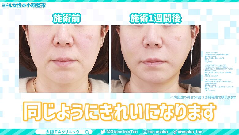 口元の施術前と1週間後の比較画像