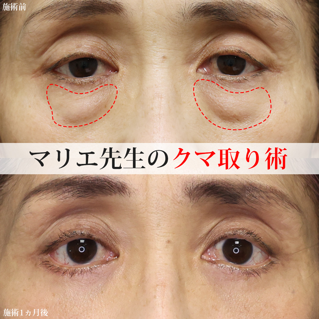 下眼瞼脱脂術（目の下のたるみ取り・目の下の脂肪ふくらみ取り）/下眼瞼切開術（クマ・たるみとり）の症例写真 施術前後 
