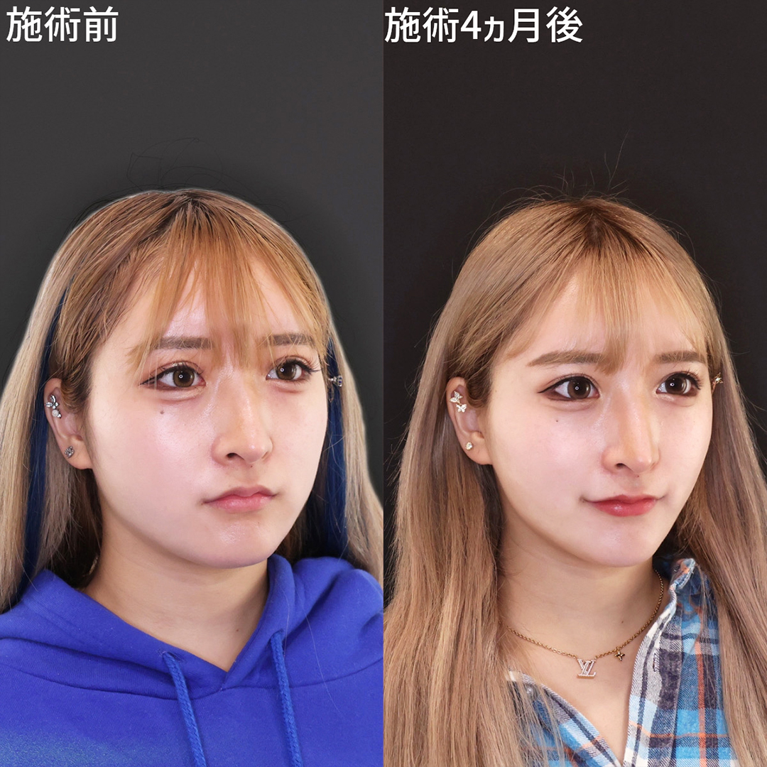 TAC式 ツヤ肌コラーゲンリフト®/ジョールファット除去の症例写真 施術前後 