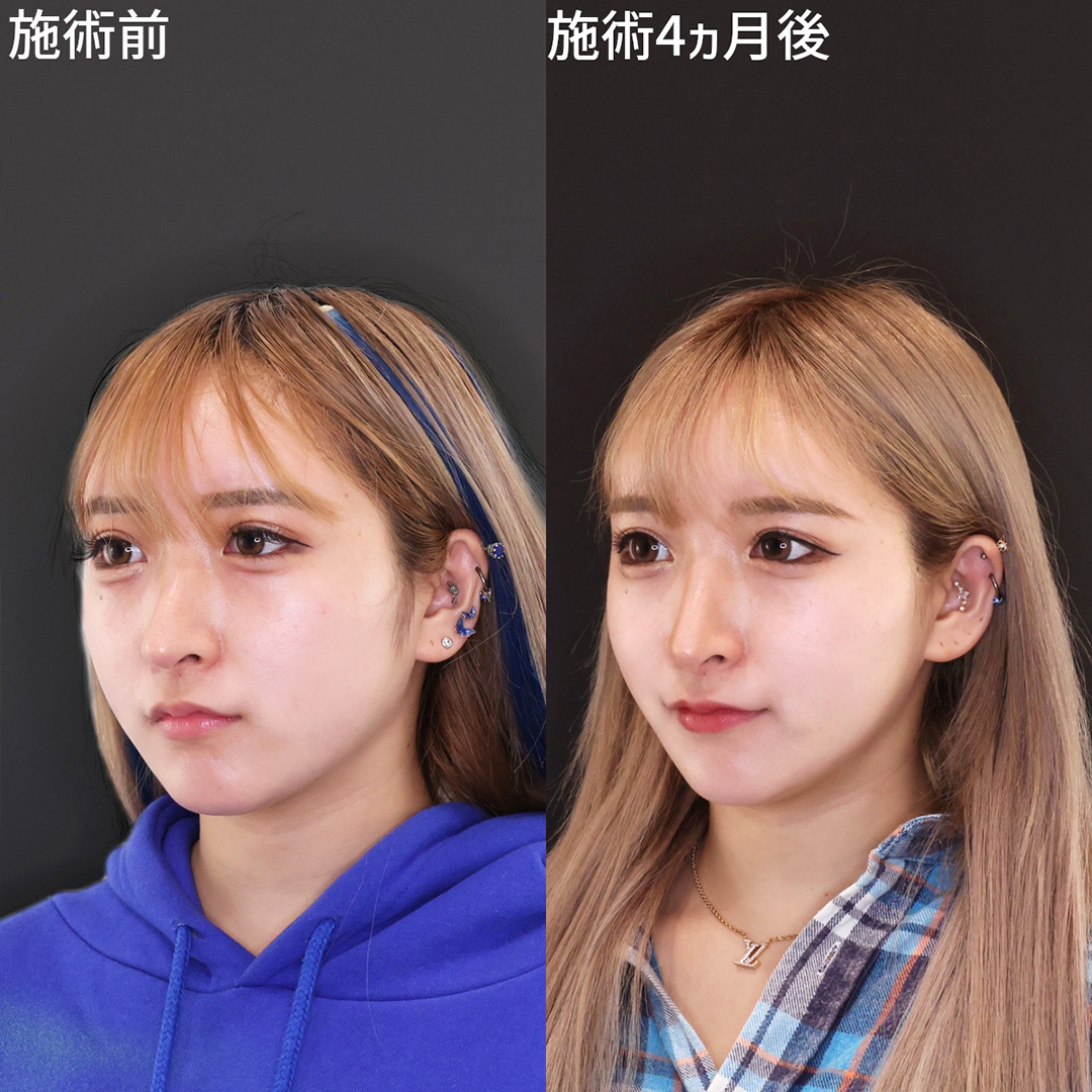 TAC式 ツヤ肌コラーゲンリフト®/ジョールファット除去の症例写真 施術前後 