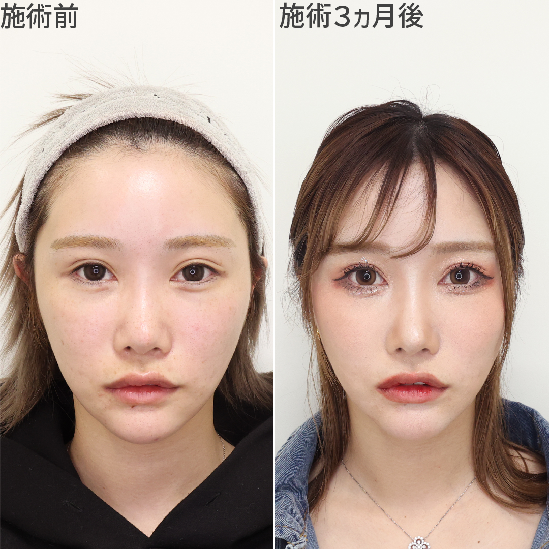 TAC式 ツヤ肌コラーゲンリフト®/ジョールファット除去/エラボトックス注射の症例写真 施術前後