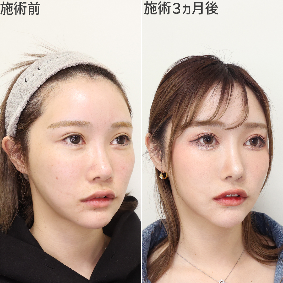 TAC式 ツヤ肌コラーゲンリフト®/ジョールファット除去/エラボトックス注射の症例写真 施術前後